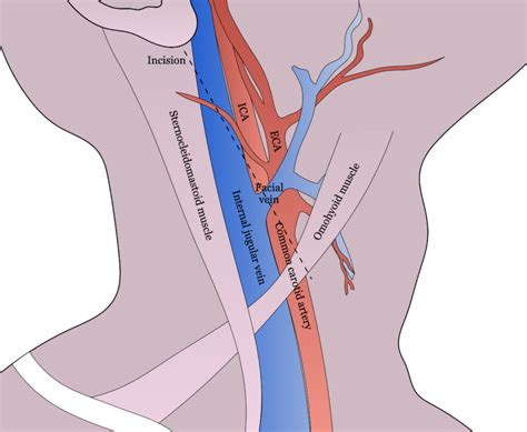 Carotid Endarterectomy Surgery Student