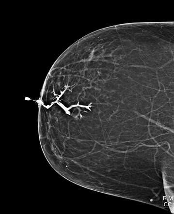 Intraductal Papilloma In A Year Old Woman Conventional Ductogram Hot