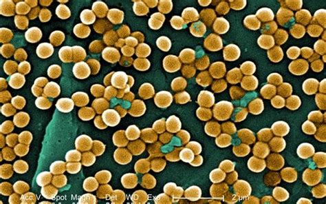 La Infecci N Por Staphylococcus Aureus Es La M S Frecuente En Los