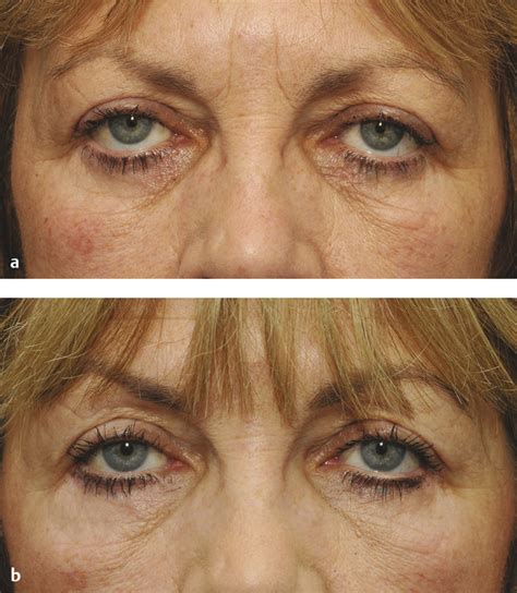 16 Complications Of Blepharoplasty Plastic Surgery Key