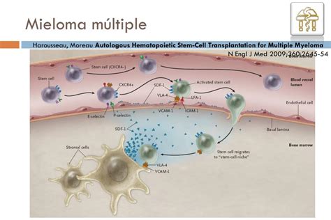 PPT Mieloma múltiple PowerPoint Presentation free download ID 1806204