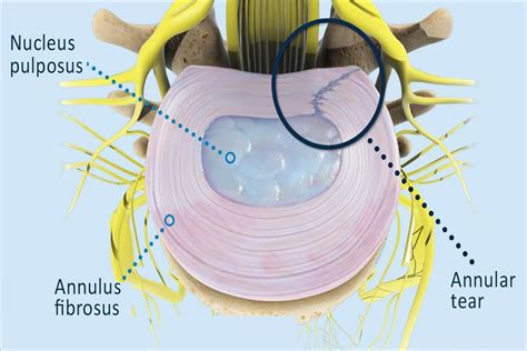 When Does an Annular Tear Require Surgery | Spine & Orthopedic Center