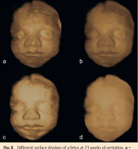 Figure From D Imaging Of The Fetal Face Recommendations From The