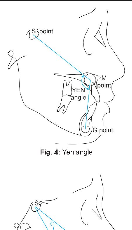 Figure 5 From Comparative Evaluation Of Yen Angle And W Angle With Anb Angle Wits Appraisal