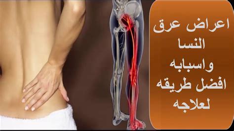 افضل 3 تمارين لعلاج عرق النسا اعراض عرق النسا و اسبابه Youtube