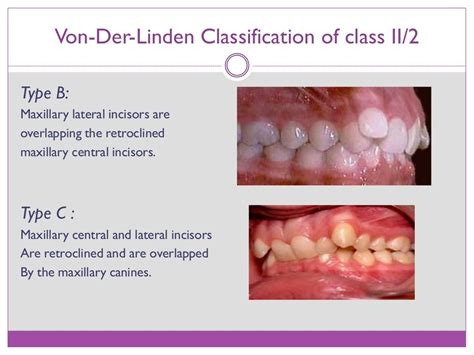 Class II Division 2 Malocclusion