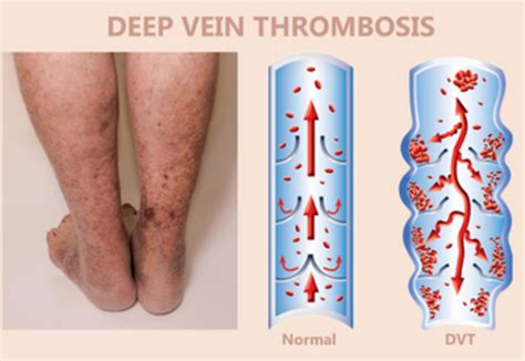 Deep Venous Thrombosis Dvt Treatment By Ivc Filter Placement Thrombolysis And Thrombectomy Dr