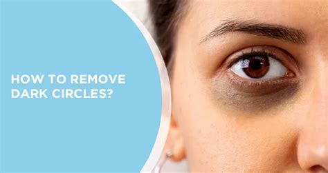 How To Remove Dark Circles Naturally At Home Treatment Tips