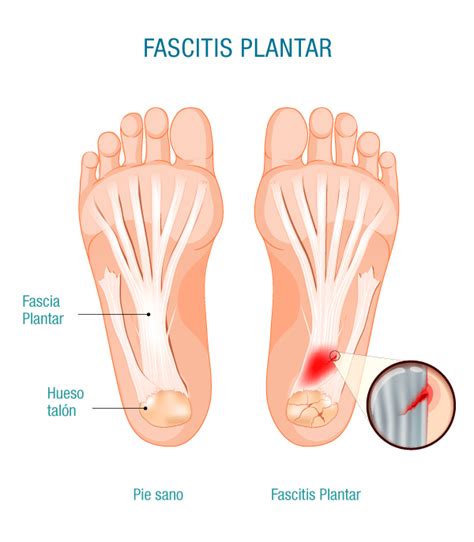 Fascitis Plantar En Bilbao Causas S Ntomas Y Tratamientos Efectivos