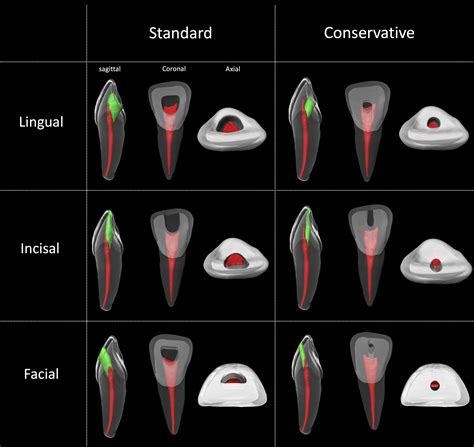 Access Cavity Preparations Classification And Literature Review Of