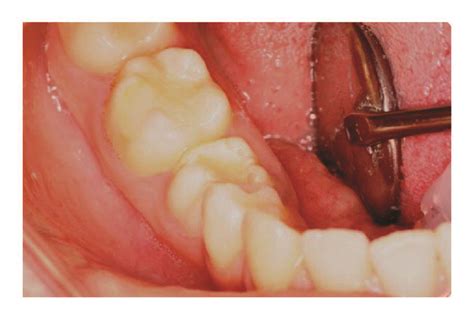 Preoperative Intraoral And Radiographic Views Of The Patient A