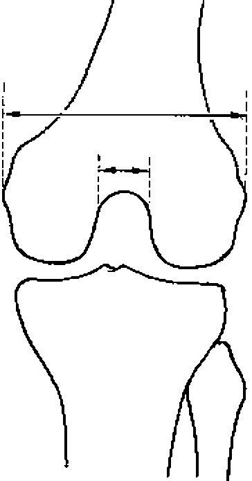 Intercondylar Notch Width A And Notch Width Index A B Download