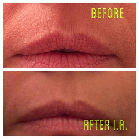 2 minute miracle on smokers lips Latina, Instantly Ageless, Lip ...