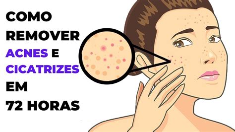 Como Remover Acnes E Cicatrizes Em 72 Horas YouTube