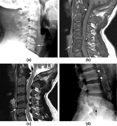 Various Musculoskeletal Manifestations Of Chronic Renal Insufficiency Clinical Radiology