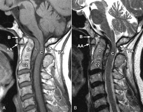 Os Odontoideum | Radiology Key