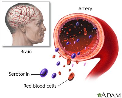 Carcinoid Syndrome Symptoms, Doctors, Treatments, Advances & More | MediFind