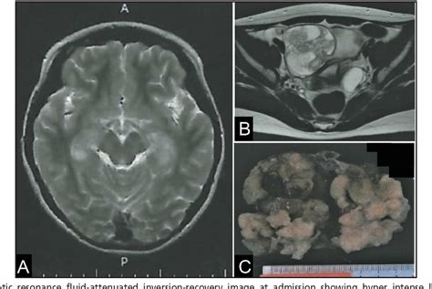 Figure From Immature Ovarian Teratoma With Anti Nmda Receptor