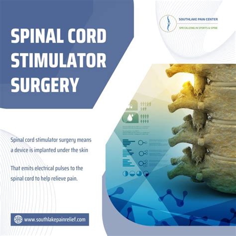 Spinal cord stimulator – Artofit