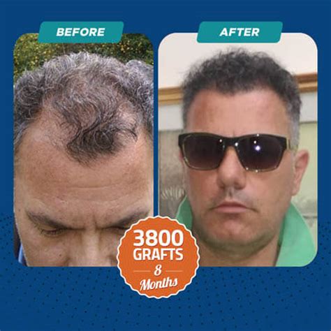 Hair Transplant Without Shaving In Turkey DR CELEN