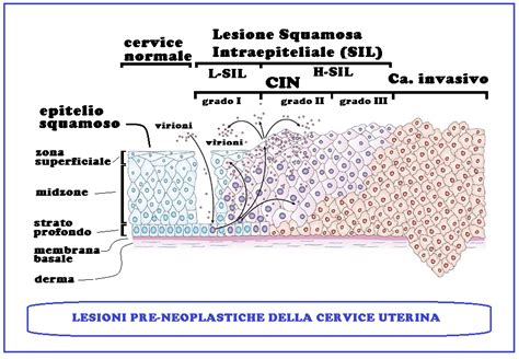 Lesioni Pre Neoplastiche Della Cervice Uterina Cin Sil Asc Us