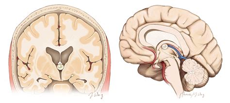 Colloid Cyst Prognosis