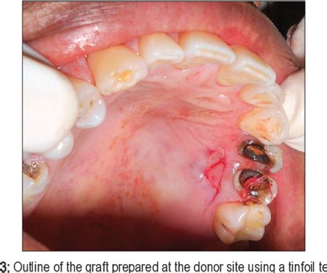 Figure 1 From Root Coverage Of A Wide Anterior Mucogingival Defect With