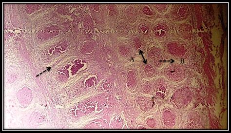 GROUP(4) bursa of fabricius section atrophy of lymphoid follicles,... | Download Scientific Diagram