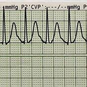 An ECG Strip Of Narrow Complex Tachycardia ECG Electrocardiogram