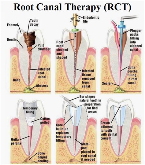 Endodontic Basics