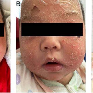 Skin Manifestation Evolution Of A Patient With Staphylococcal Scalded