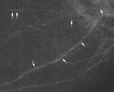 A Mammogram Showing Linear Calcifications In Two Breast Arteries