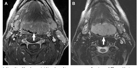 Figure 4 From Imaging Hodgkin And Non Hodgkin Lymphoma In The Head And Neck Semantic Scholar