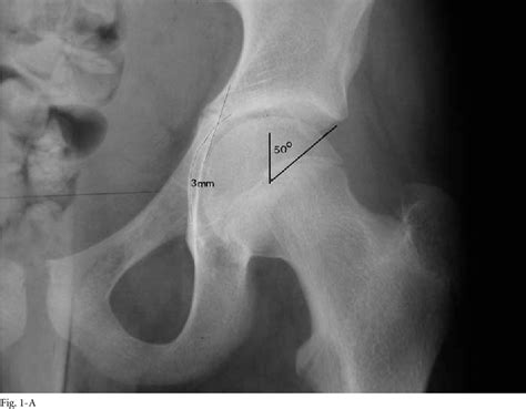 Figure From Protrusio Acetabuli In Marfan Syndrome Age Related