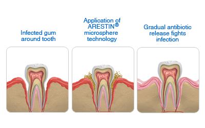 Arestin Plymouth MA, Periodontal Disease