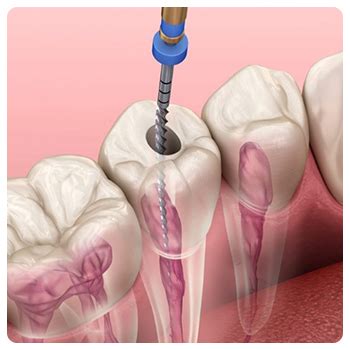 Root Canal Treatment My Dentist Turkey