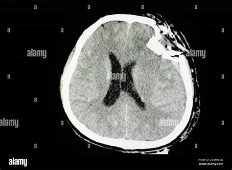 Skull Fracture Hi Res Stock Photography And Images Alamy