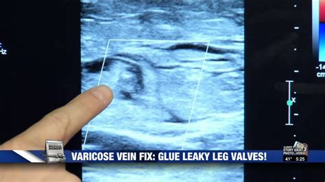 Varicose Vein Fix Glue Leaky Leg Valves