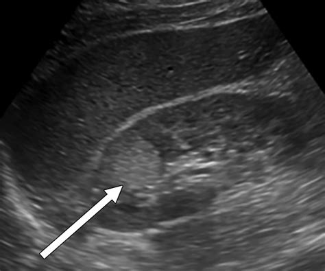 Ct Guided Biopsy Of Entirely Endophytic Small Renal Masses Diagnostic