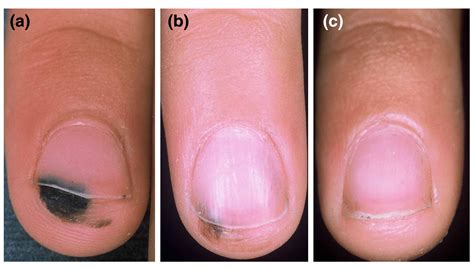 Hutchinson Sign Nail Melanoma - Nail Ftempo