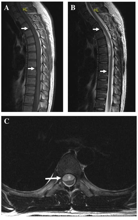 Magnetic Resonance Imaging Of The Thoracic Spine A Sagittal Download Scientific Diagram