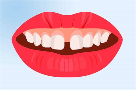 Maloclusión Dental ¿qué Es Y Cómo Corregirla