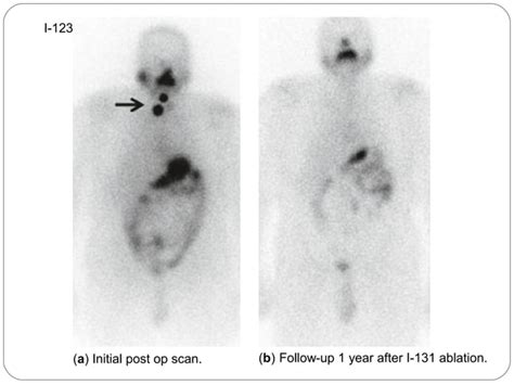 Radionuclide Imaging Thyroid And Parathyroid Ppt