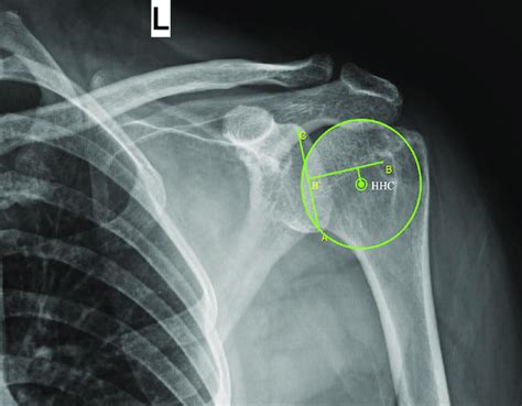 Anteroposterior Shoulder Radiography Demonstrating Center Equator Download Scientific Diagram