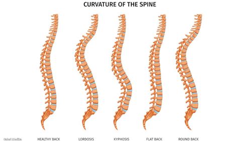 Lordosis Penyebab Gejala Dan Cara Mengobati Galeri Medika