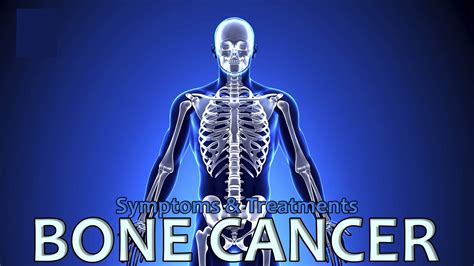 Bone Cancer - Causes, Types, Signs, Symptoms,Treatment