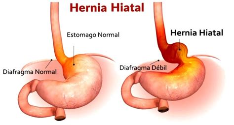 Esfínter Esofágico O Enfermedad De Reflujo Gastroesofágico Erge