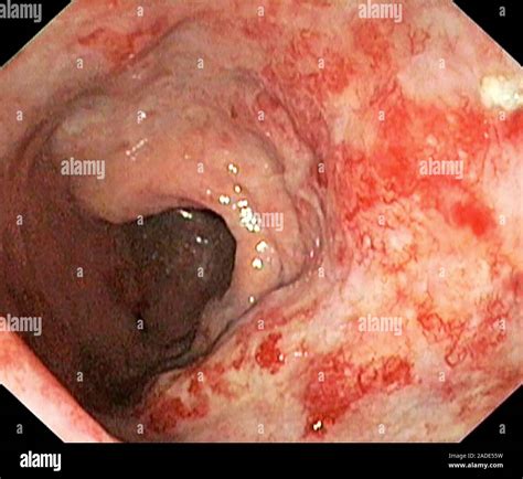 Proctitis Following Radiotherapy Treatment Endoscopic View Of Ulceration And Inflammation