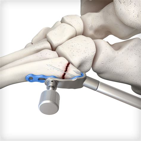 5th Metatarsal Hook Plates Unite Foot And Ankle