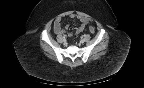 Appendix Mucocele Image